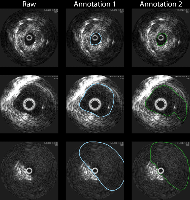 Figure 4 for U-Net-and-a-half: Convolutional network for biomedical image segmentation using multiple expert-driven annotations