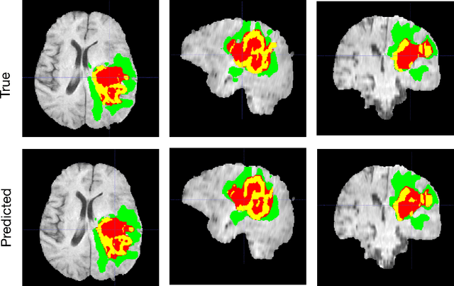 Figure 2 for Robust Semantic Segmentation of Brain Tumor Regions from 3D MRIs