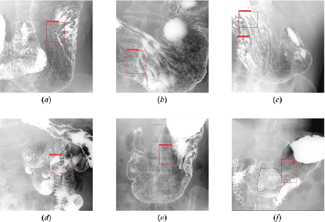 Figure 4 for Gastric Cancer Detection from X-ray Images Using Effective Data Augmentation and Hard Boundary Box Training