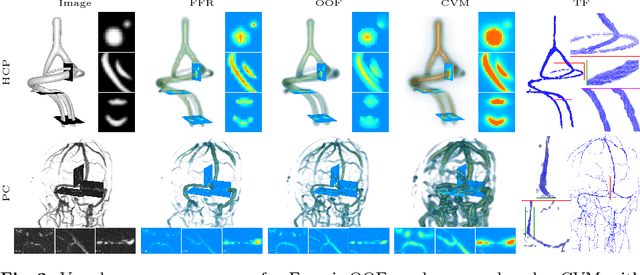 Figure 4 for VTrails: Inferring Vessels with Geodesic Connectivity Trees