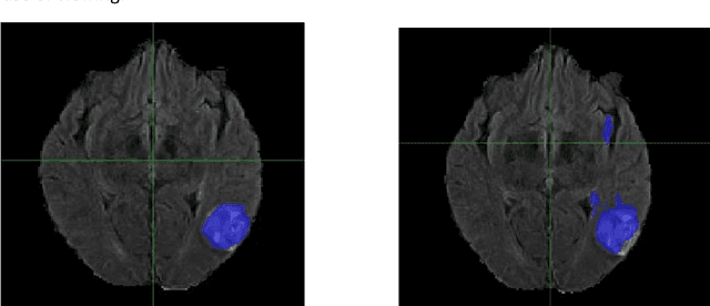 Figure 3 for Improvement of Multiparametric MR Image Segmentation by Augmenting the Data with Generative Adversarial Networks for Glioma Patients