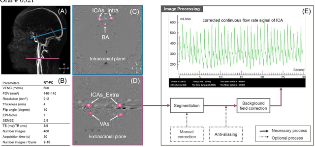 Figure 1 for Real-Time Phase Contrast MRI to quantify Cerebral arterial flow change during variations breathing