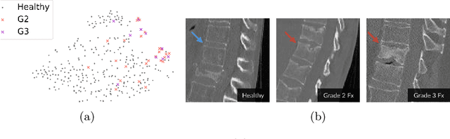 Figure 1 for Grading Loss: A Fracture Grade-based Metric Loss for Vertebral Fracture Detection