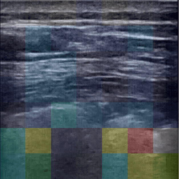 Figure 4 for Adaptive Few-Shot Learning PoC Ultrasound COVID-19 Diagnostic System