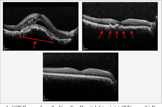 Figure 1 for Multi-Scale Convolutional Neural Network for Automated AMD Classification using Retinal OCT Images