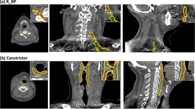 Figure 4 for Exploring the combination of deep-learning based direct segmentation and deformable image registration for cone-beam CT based auto-segmentation for adaptive radiotherapy