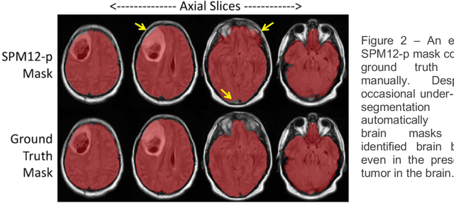 Figure 3 for Robust Automatic Whole Brain Extraction on Magnetic Resonance Imaging of Brain Tumor Patients using Dense-Vnet