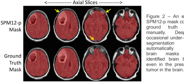 Figure 3 for Robust Automatic Whole Brain Extraction on Magnetic Resonance Imaging of Brain Tumor Patients using Dense-Vnet