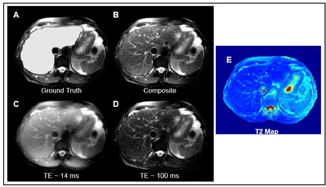 Figure 4 for A Comparison of Deep Learning Convolution Neural Networks for Liver Segmentation in Radial Turbo Spin Echo Images