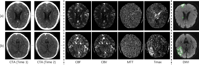 Figure 1 for Automatic Ischemic Stroke Lesion Segmentation from Computed Tomography Perfusion Images by Image Synthesis and Attention-Based Deep Neural Networks