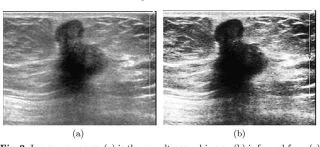 Figure 3 for Breast Cancer Classification with Ultrasound Images Based on SLIC