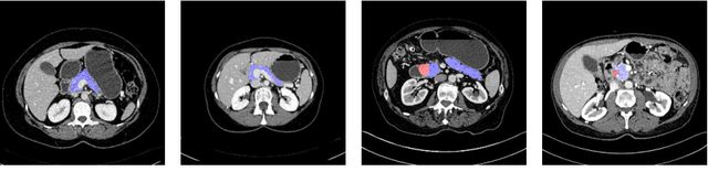 Figure 1 for Multi-Scale Coarse-to-Fine Segmentation for Screening Pancreatic Ductal Adenocarcinoma