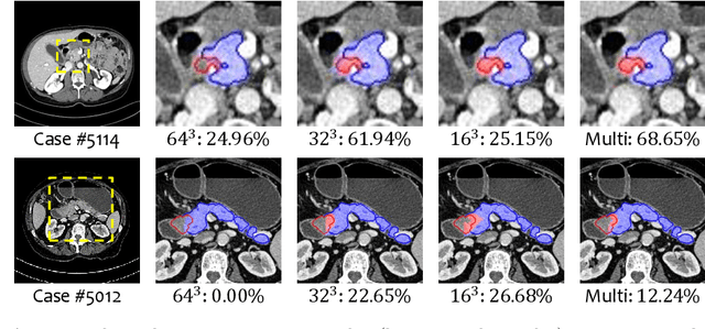 Figure 4 for Multi-Scale Coarse-to-Fine Segmentation for Screening Pancreatic Ductal Adenocarcinoma