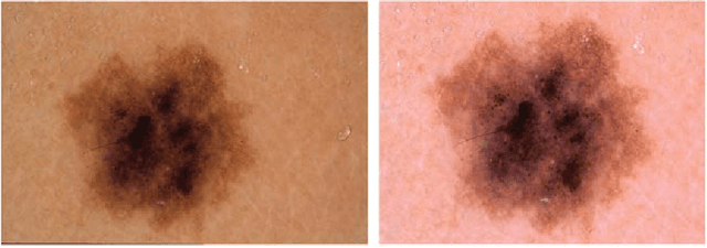 Figure 3 for The HAM10000 Dataset: A Large Collection of Multi-Source Dermatoscopic Images of Common Pigmented Skin Lesions