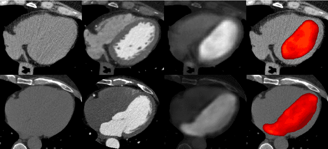 Figure 4 for Synthetic contrast enhancement in cardiac CT with Deep Learning