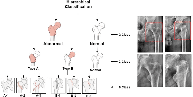 Figure 1 for Weakly-Supervised Localization and Classification of Proximal Femur Fractures