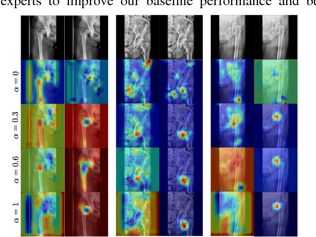 Figure 3 for Weakly-Supervised Localization and Classification of Proximal Femur Fractures