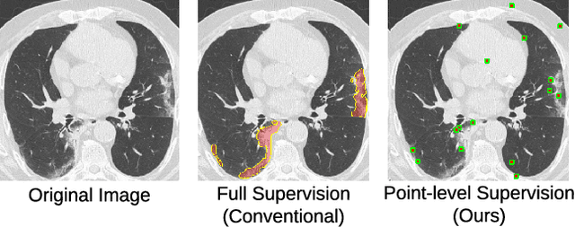 Figure 1 for A Weakly Supervised Consistency-based Learning Method for COVID-19 Segmentation in CT Images