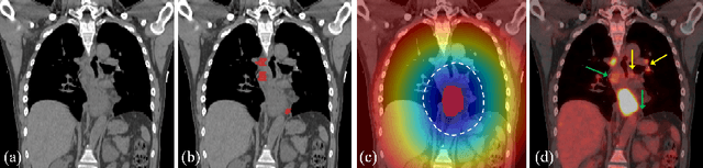 Figure 3 for Detecting Scatteredly-Distributed, Small, andCritically Important Objects in 3D OncologyImaging via Decision Stratification