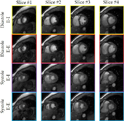 Figure 3 for Joint alignment and reconstruction of multislice dynamic MRI using variational manifold learning