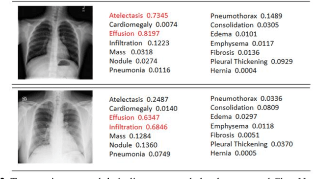 Figure 3 for ChestNet: A Deep Neural Network for Classification of Thoracic Diseases on Chest Radiography