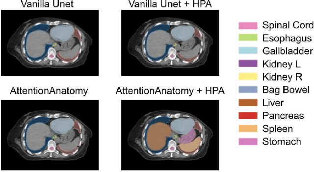 Figure 3 for AttentionAnatomy: A unified framework for whole-body organs at risk segmentation using multiple partially annotated datasets