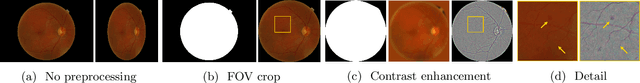 Figure 2 for A ResNet is All You Need? Modeling A Strong Baseline for Detecting Referable Diabetic Retinopathy in Fundus Images