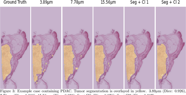 Figure 4 for Automatic tumour segmentation in H&E-stained whole-slide images of the pancreas