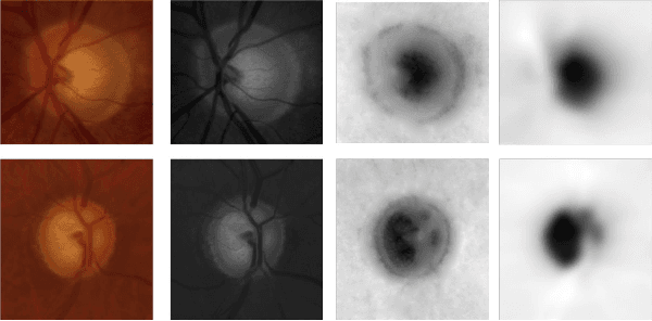 Figure 3 for Fully Convolutional Networks for Monocular Retinal Depth Estimation and Optic Disc-Cup Segmentation