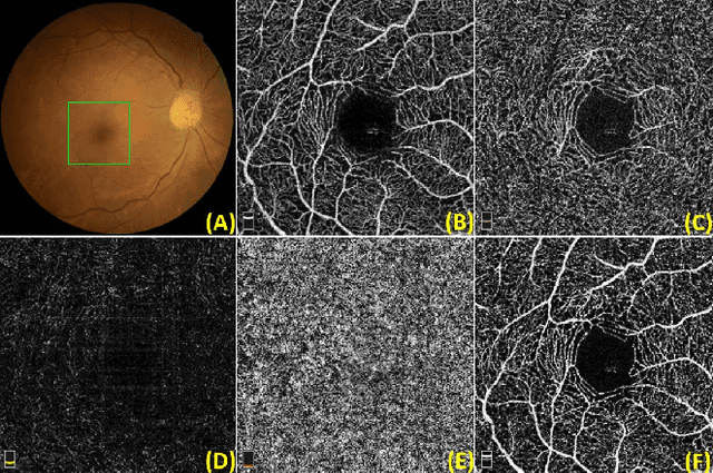 Figure 1 for ROSE: A Retinal OCT-Angiography Vessel Segmentation Dataset and New Model