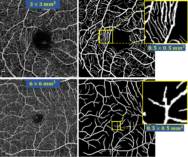 Figure 2 for ROSE: A Retinal OCT-Angiography Vessel Segmentation Dataset and New Model