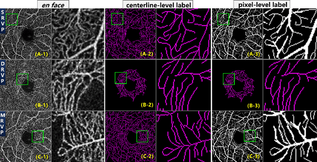 Figure 3 for ROSE: A Retinal OCT-Angiography Vessel Segmentation Dataset and New Model