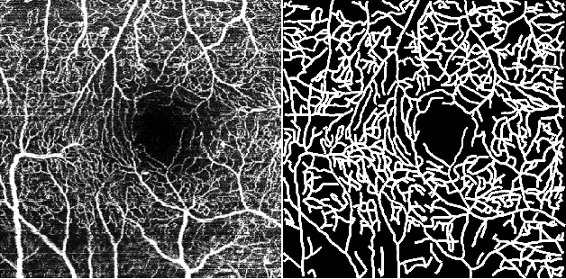 Figure 4 for ROSE: A Retinal OCT-Angiography Vessel Segmentation Dataset and New Model