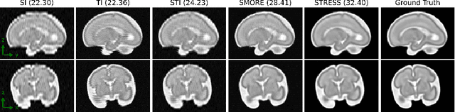 Figure 3 for STRESS: Super-Resolution for Dynamic Fetal MRI using Self-Supervised Learning