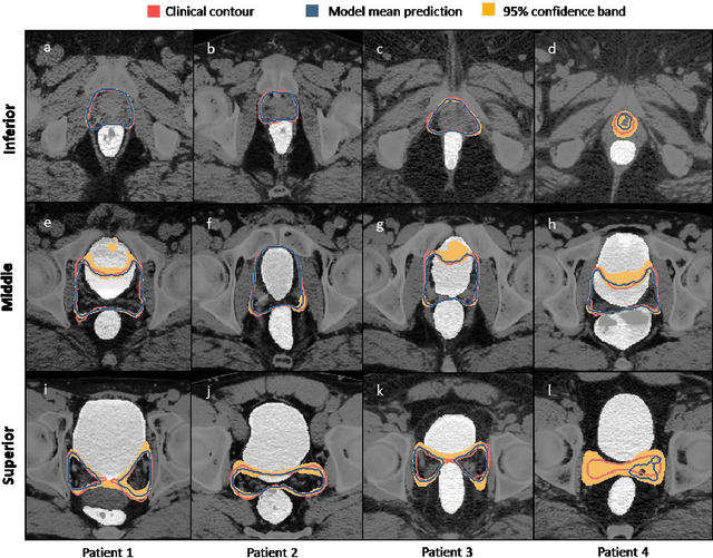 Figure 3 for A deep learning-based framework for segmenting invisible clinical target volumes with estimated uncertainties for post-operative prostate cancer radiotherapy