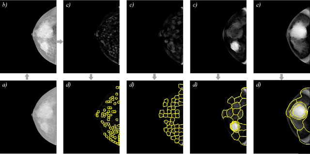 Figure 1 for Leveraging SLIC Superpixel Segmentation and Cascaded Ensemble SVM for Fully Automated Mass Detection In Mammograms