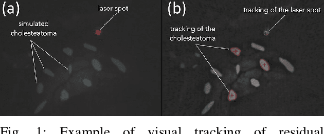 Figure 1 for Automatic laser steering for middle ear surgery