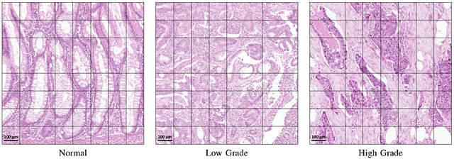 Figure 1 for Context-Aware Convolutional Neural Network for Grading of Colorectal Cancer Histology Images