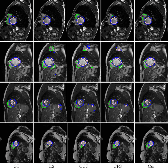 Figure 4 for Semi-Supervised Medical Image Segmentation via Cross Teaching between CNN and Transformer