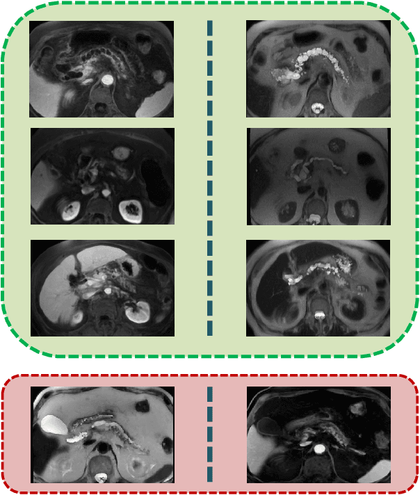 Figure 4 for Deep Multi-Modal Classification of Intraductal Papillary Mucinous Neoplasms (IPMN) with Canonical Correlation Analysis