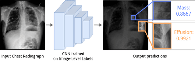 Figure 1 for Self-Guided Multiple Instance Learning for Weakly Supervised Disease Classification and Localization in Chest Radiographs