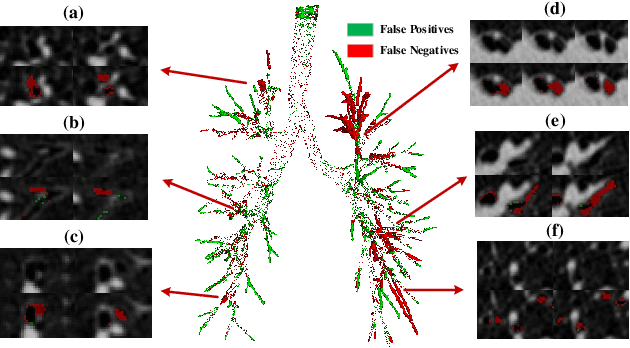 Figure 2 for Alleviating Class-wise Gradient Imbalance for Pulmonary Airway Segmentation