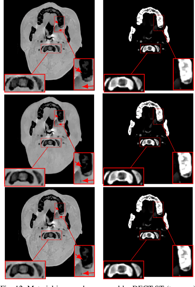 Figure 4 for DECT-MULTRA: Dual-Energy CT Image Decomposition With Learned Mixed Material Models and Efficient Clustering