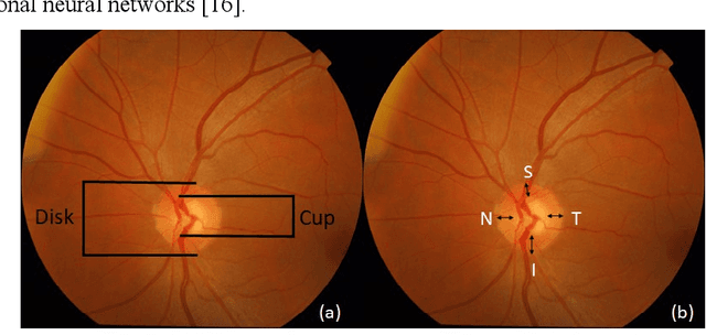 Figure 1 for Rapid Classification of Glaucomatous Fundus Images