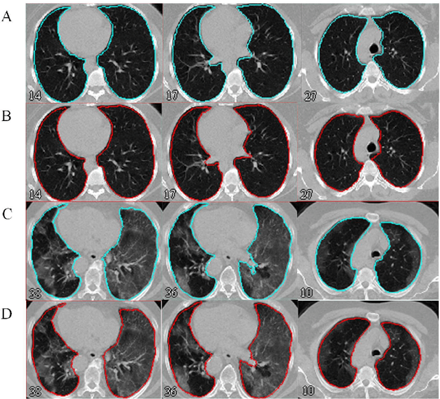 Figure 2 for Automated lung segmentation from CT images of normal and COVID-19 pneumonia patients