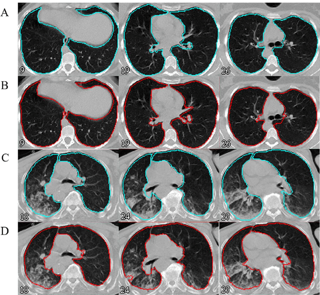 Figure 3 for Automated lung segmentation from CT images of normal and COVID-19 pneumonia patients