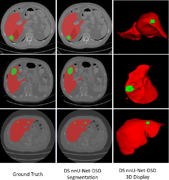 Figure 2 for Multi-Slice Dense-Sparse Learning for Efficient Liver and Tumor Segmentation