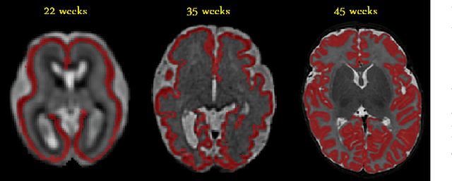 Figure 4 for Improving Calibration and Out-of-Distribution Detection in Medical Image Segmentation with Convolutional Neural Networks