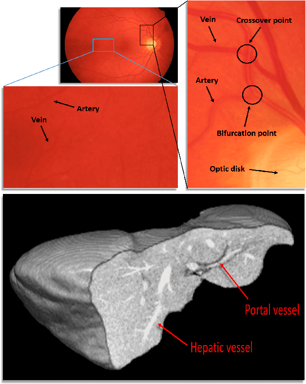 Figure 1 for Hierarchical Deep Network with Uncertainty-aware Semi-supervised Learning for Vessel Segmentation