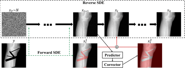 Figure 1 for Metal Inpainting in CBCT Projections Using Score-based Generative Model